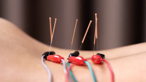 electro acupuncture on back